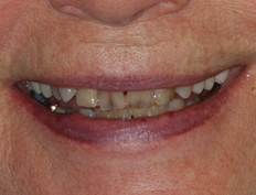 Veneers Before and After