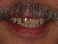 Veneers Before and After
