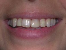 Veneers Before and After