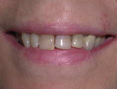Veneers Before and After
