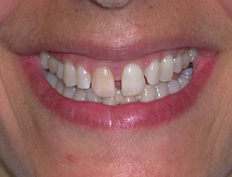 Veneers Before and After