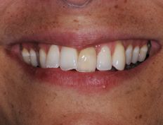 Veneers Before and After