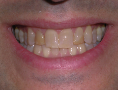 Whitening Before and After