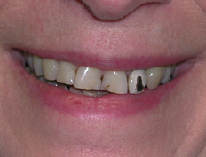 Veneers Before and After