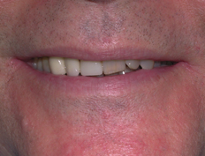 Veneers Before and After