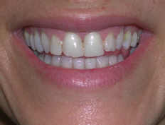 Veneers Before and After
